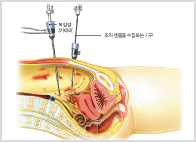 복강경 진단